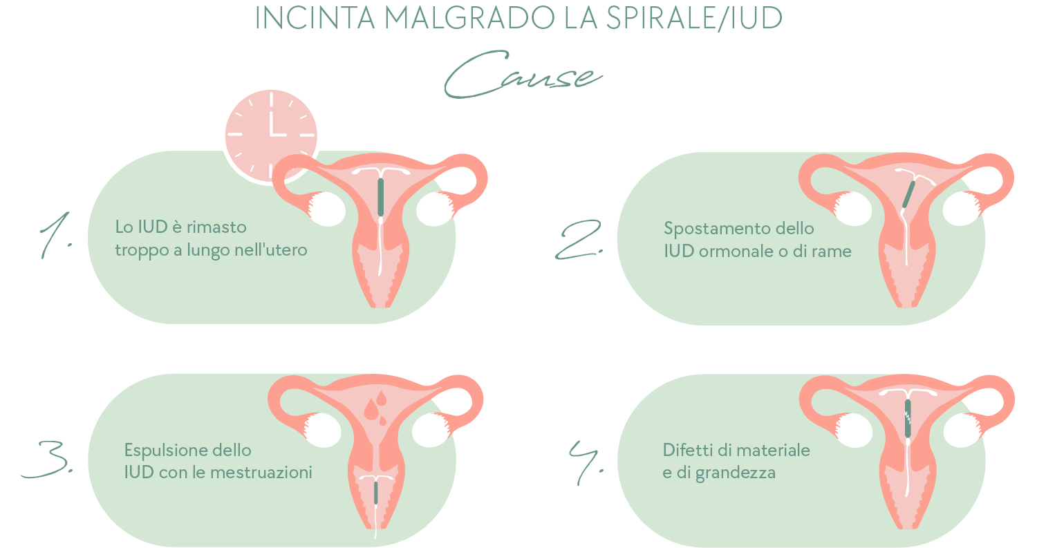 Incinta malgrado la IUD